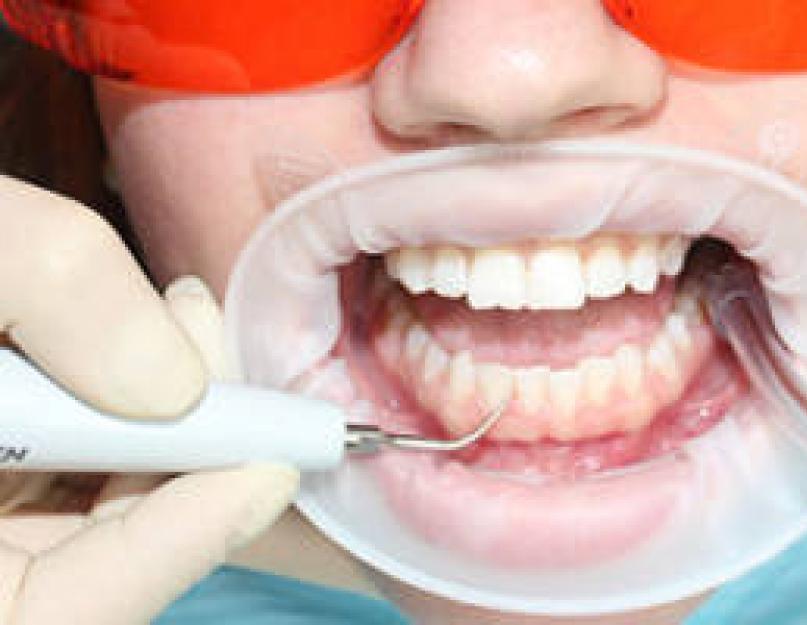 Чистка зубов от зубного камня air flow. Чистка зубов «Air Flow»: описание процедуры, плюсы и минусы, отзывы. Когда нужна чистка зубов Air Flow