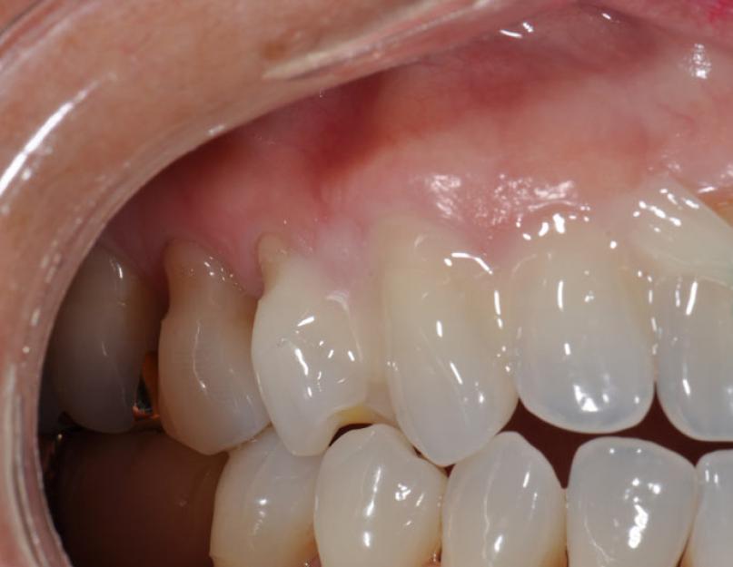 Рем терапия для зубов. Ремотерапия — профилактическое насыщение зубной эмали ионами кальция и фтора. Когда необходима процедура