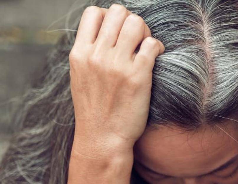 Женское и мужское выпадение волос из-за проблем со щитовидкой. Как остановить выпадение волос при гипотиреозе? Выпадение волос у женщин причины щитовидка