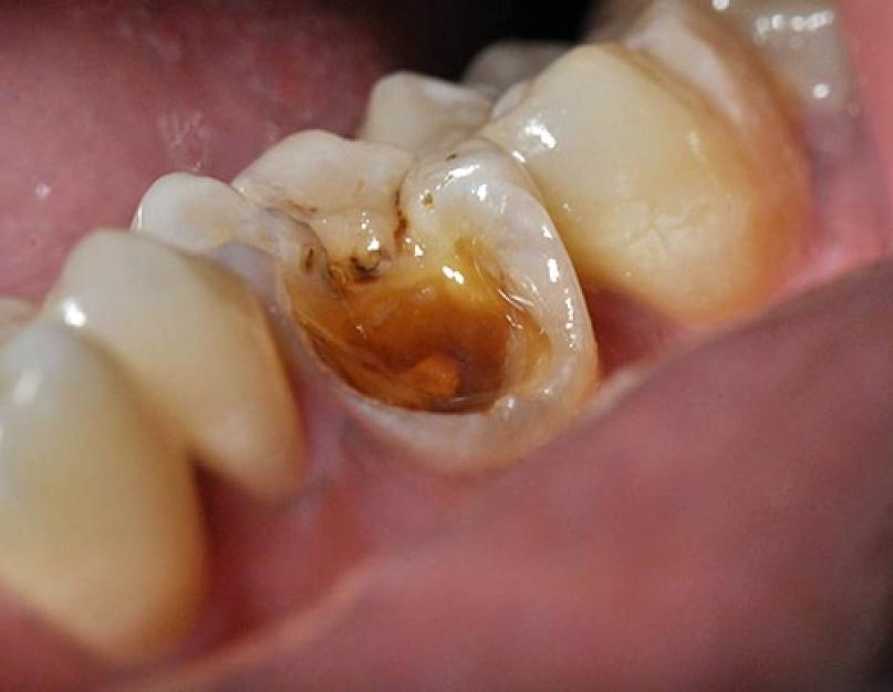 Портится ли зуб под коронкой. Может ли из-под коронки возникать плохой запах и как его устранить? Что делать при разрушении зуба и корня