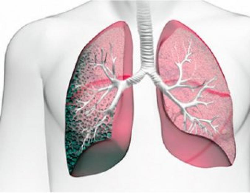 Что такое фиброз лёгких и чем он опасен? Инволютивный фиброз молочных желез симптомы и лечение Диффузные фиброзные изменения молочных желез что