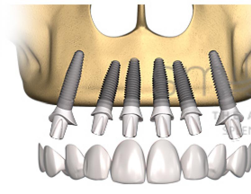 Протезирование на имплантах при полном отсутствии зубов. Избавиться от неудобной вставной челюсти поможет полная имплантация зубов Все о имплантации верхней челюсти