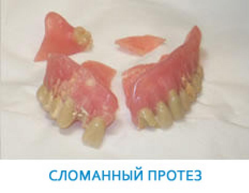 Чем заклеить зубной протез в домашних. Склеивание в домашних условиях зубного протеза, искусственного зуба. Можно ли приклеить отколовшийся зуб