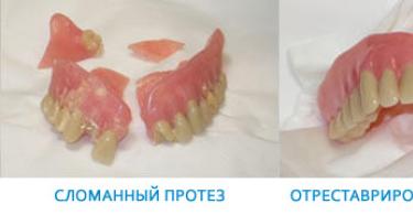 Склеивание в домашних условиях зубного протеза, искусственного зуба