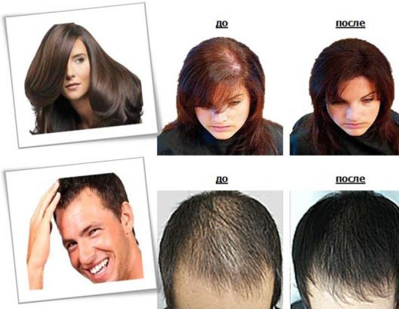 Что такое плазмолифтинг волосистой части головы. Плазмолифтинг для волос — как работает методика и насколько она эффективна. Где делают плазмолифтинг головы