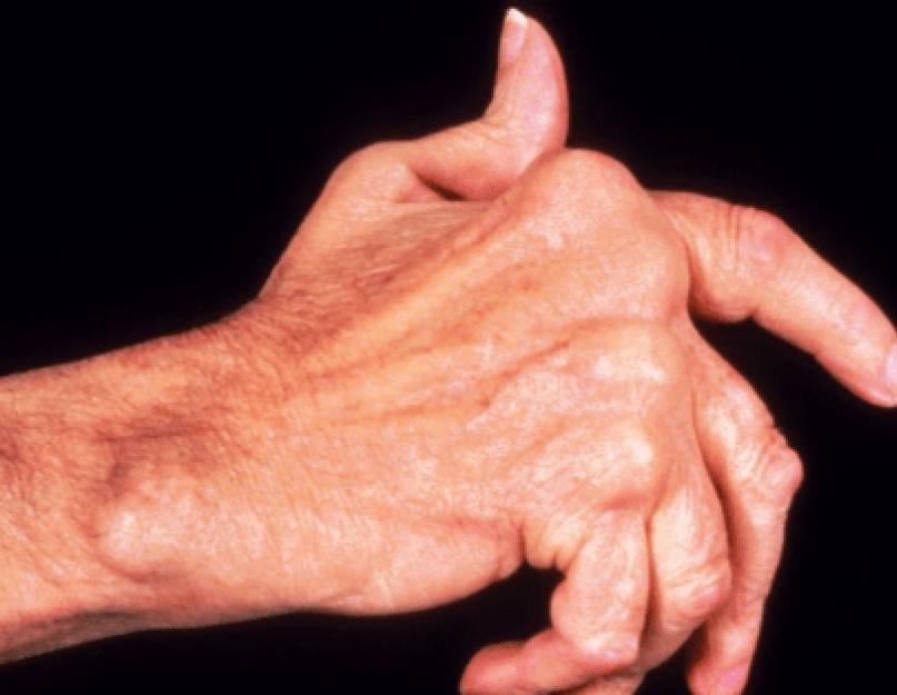 Mida teha, kui sõrmi mõjutab polüartriit?  Kui teie sõrmed valutavad ja ei suru rusikasse, peate võtma ühendust reumatoloogiga