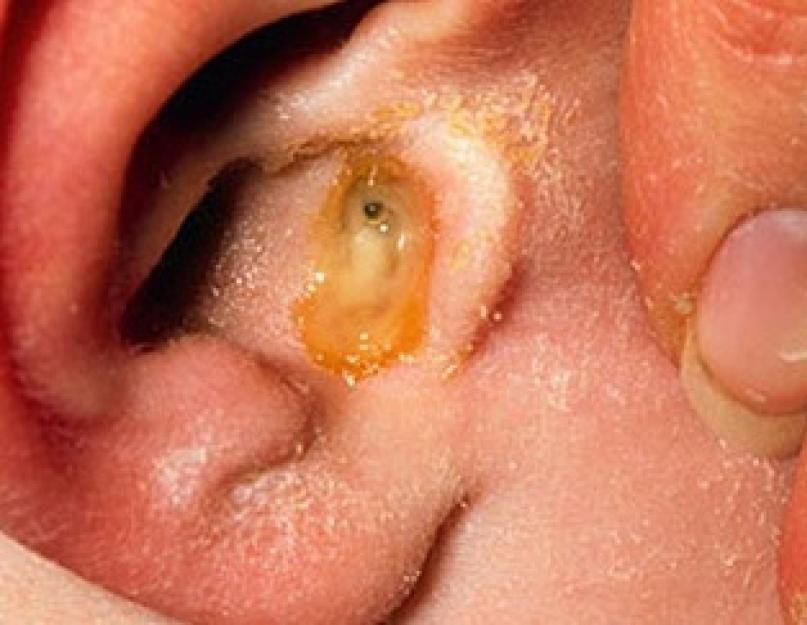 सल्फर प्लग कैसे निकालें।  कान में सल्फर प्लग - कारण, लक्षण, निदान, धुलाई या शुष्क विधि द्वारा हटाना।  क्या सल्फ्यूरिक प्लग से कान में दर्द होता है?