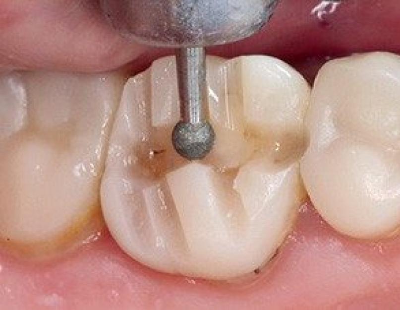 Как ставят коронку на зуб – этапы изготовления и установки коронки. Как делают коронку на зуб, этапы изготовления и установки Коронка на зуб виды