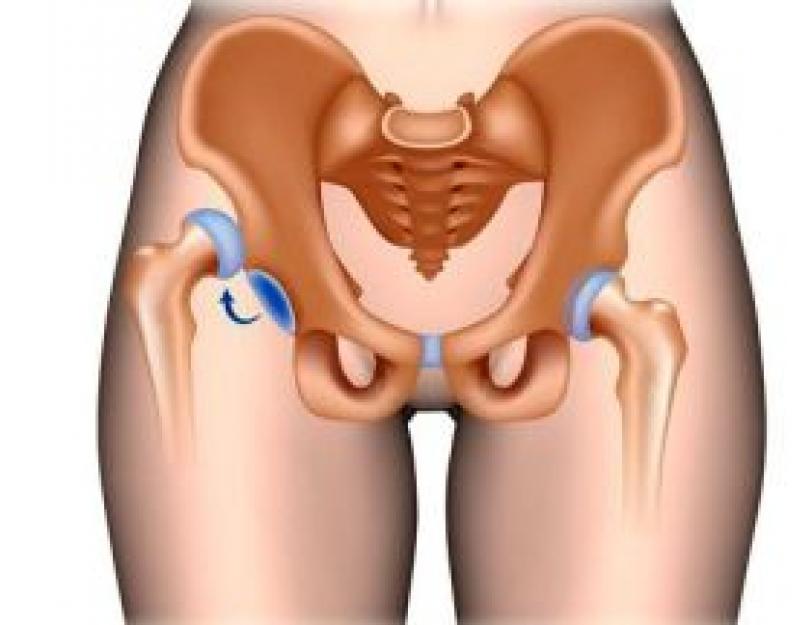 हिप ऑर्थोसिस की आवश्यकता किसे है और यह क्या है?  कूल्हे के जोड़ पर पट्टी: सामान्य विवरण, प्रकार और गुण