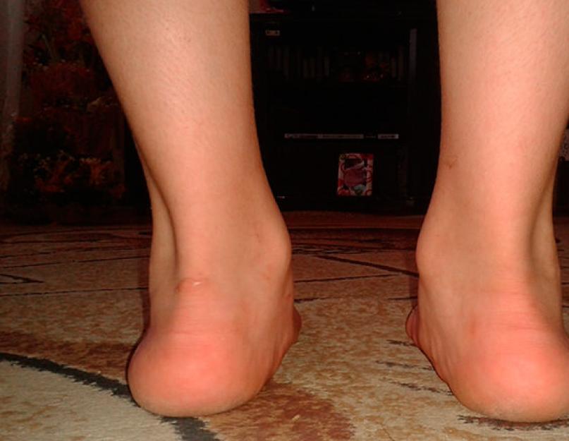 वयस्कों में वल्गस का इलाज कैसे करें।  पैर का वल्गस विचलन।  पैर की वल्गस विकृति क्या है