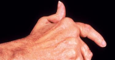 Ha az ujjai fájnak, és nem tud ökölbe szorítani, fel kell keresnie egy reumatológust