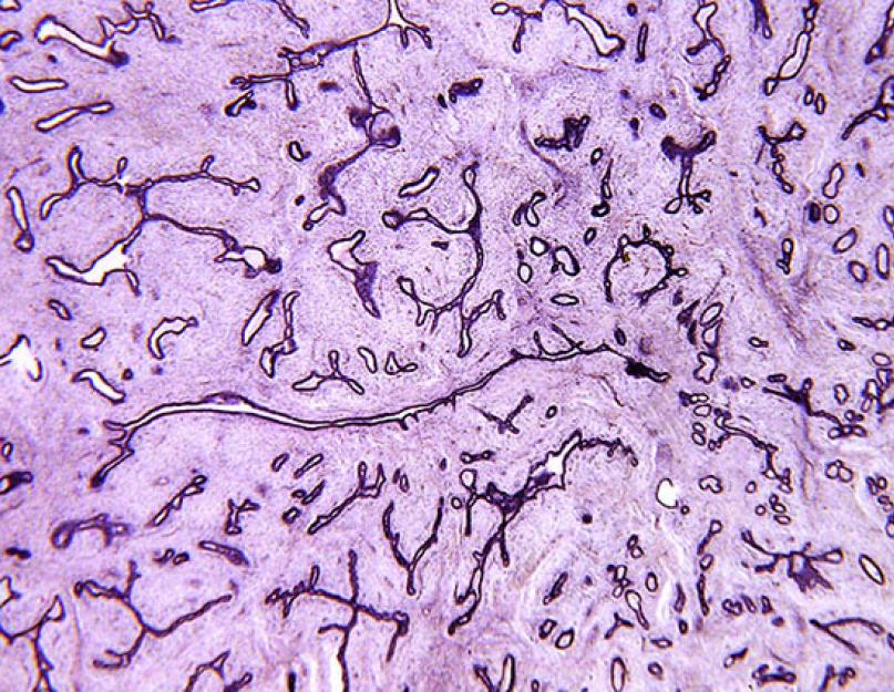 Piimanäärmete lehtedetaoline fibroadenoom.  Kuidas ravitakse rinna lehekujulist fibroadenoomi?  Muud patoloogia tunnused