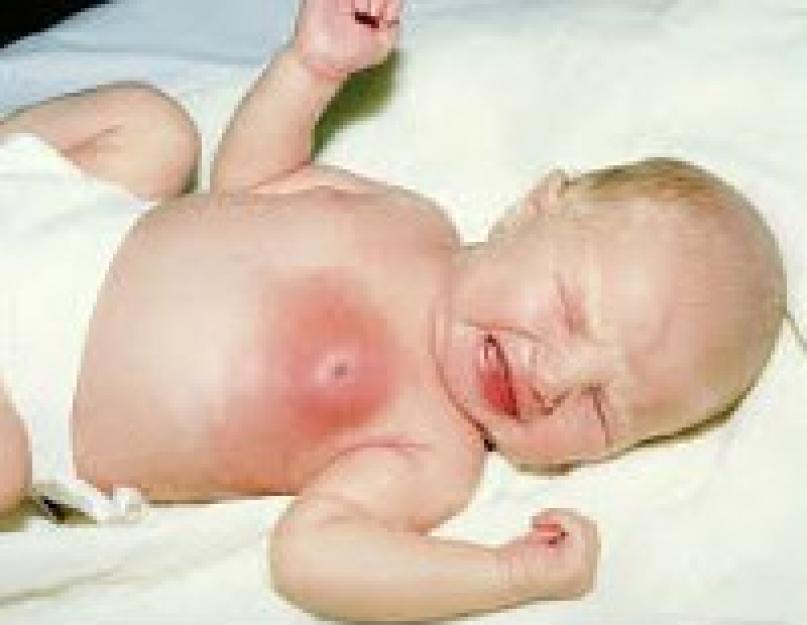 नवजात शिशुओं में प्यूरुलेंट मास्टिटिस का उपचार।  नवजात लड़कों और लड़कियों, शिशुओं में मास्टिटिस।  नवजात शिशुओं में मास्टिटिस के लक्षण