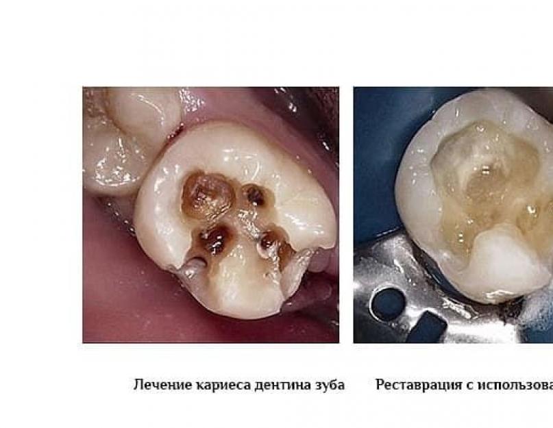 दंत क्षय का उपचार क्या है।  डेंटिन क्षरण (गहरी क्षरण)।  पैथोलॉजिकल एनाटॉमी, क्लिनिक, डायग्नोस्टिक्स, डिफरेंशियल डायग्नोस्टिक्स, उपचार।  ज्ञान के प्रारंभिक स्तर की पहचान करने के लिए प्रश्न