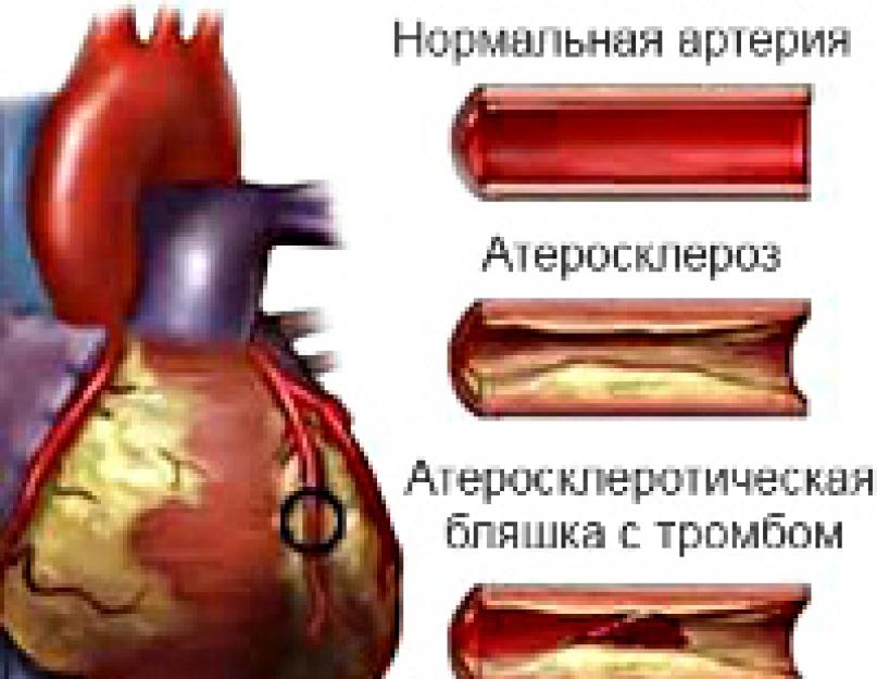 अस्थिर एनजाइना क्या है?  अस्थिर एनजाइना: दिल के दौरे का अग्रदूत अस्थिर एनजाइना दवाओं का उपचार