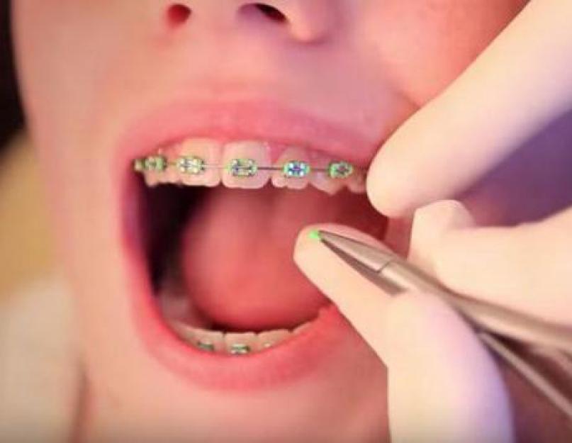 Millised aistingud tekivad sulgudes.  Kas hammastele breketite panemine on valus: ebameeldivad hetked, mida teha?  Kaasaegsete seadmete eelised