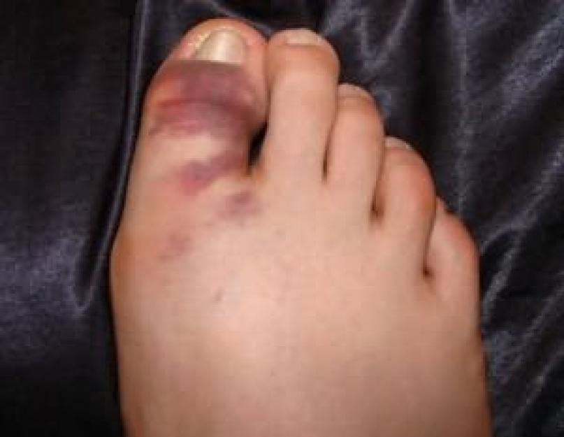 दाहिने पैर के बड़े पैर में चोट क्यों लगती है।  दाहिने पैर के बड़े पैर के अंगूठे में दर्द बड़े पैर के अंगूठे के जोड़ में गोली लगना