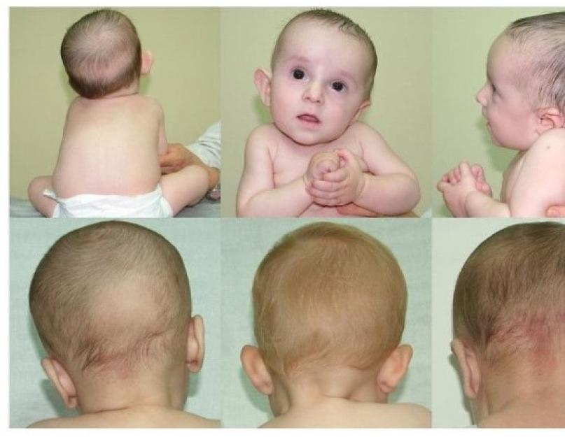 शिशुओं में टॉर्टिकोलिस: कारण और उपचार के तरीके।  शिशुओं में टॉर्टिकोलिस: कारण, संकेत, उपचार नवजात टॉर्टिकोलिस की मालिश कैसे करें