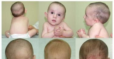 Torticollis bei Säuglingen: Ursachen, Anzeichen, Behandlung So massieren Sie einen neugeborenen Torticollis
