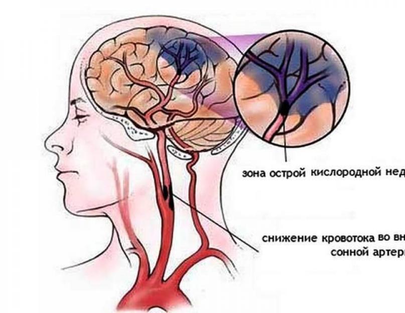 Ettekanne pp krooniline ajuisheemia.  Kroonilise ajuisheemia ravi.  Muud kroonilise ajuisheemia põhjused