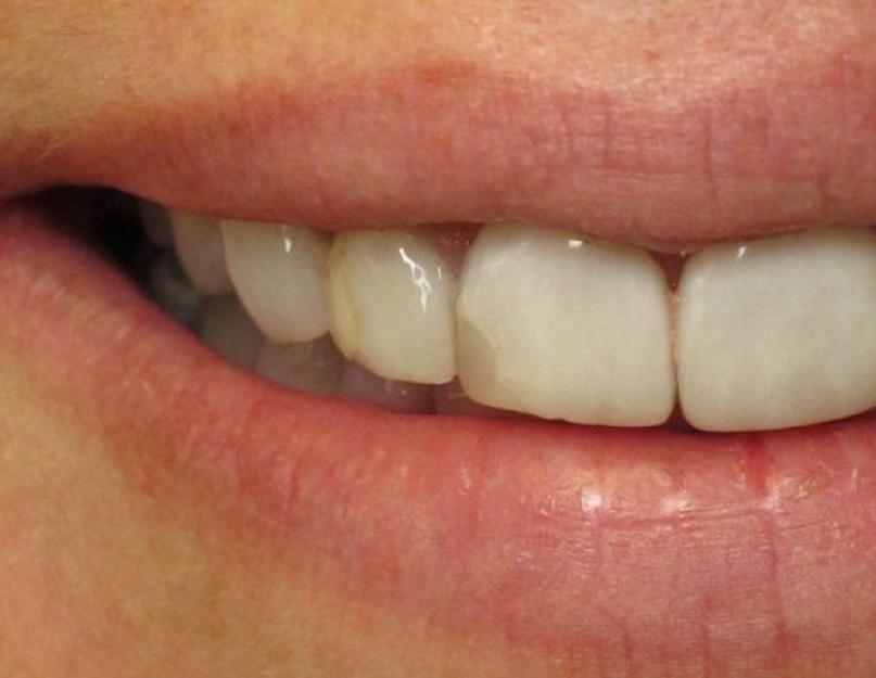 Кариозное пятно между зубами. Кариес в стадии пятна. Начальный кариес. От чего следует отличать начальный кариес