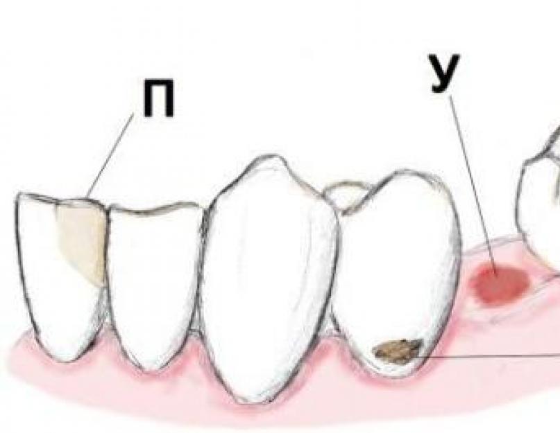 Индекс десна. Пришеечный кариес фронтальных зубов. Пришеечный кариес верхнего зуба. Пришеечный кариес нижней челюсти. Пришеечный кариес верхних резцов.