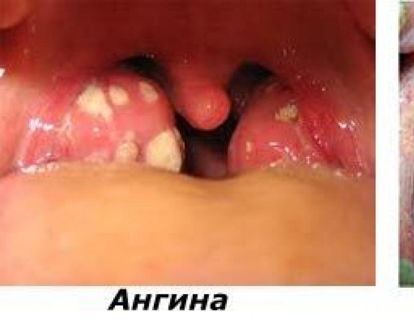 ऊपरी श्वसन पथ के संक्रामक रोग।  बच्चों और वयस्कों में श्वसन रोग श्वसन रोगों के कारण