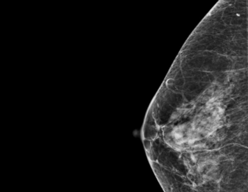 Маммография фкм. Кистозная мастопатия маммограмма. Диффузная мастопатия маммография. Диффузная фиброзная мастопатия молочных желез маммография.