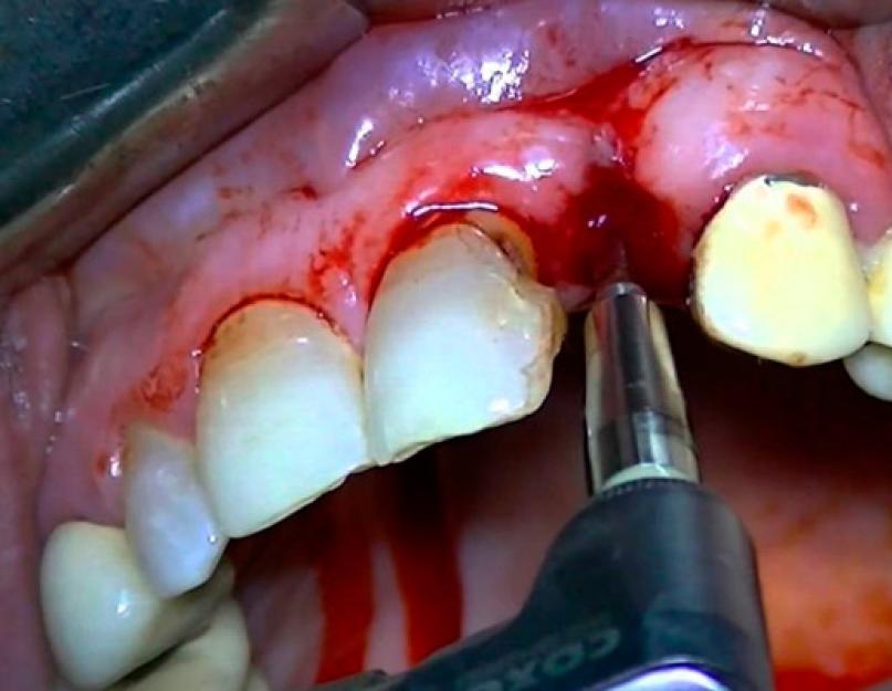 Pärast hammaste implanteerimist ma maitset ei tunne.  Mida ütleb metallimaitse suus: peamised põhjused ja diagnoos.  Närvisüsteemi haigused