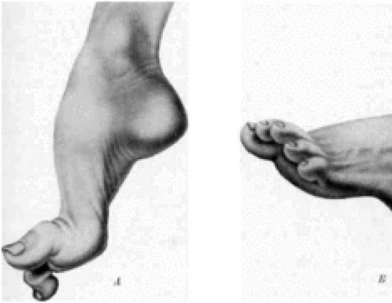 पर्क्यूटेनियस फुट सर्जरी ट्रेनिंग।  सबसे आगे की स्थिर विकृति का पर्क्यूटेनियस सर्जिकल उपचार।  स्पेन में पैर के उपचार के लिए पर्क्यूटेनियस सर्जरी के क्या लाभ हैं