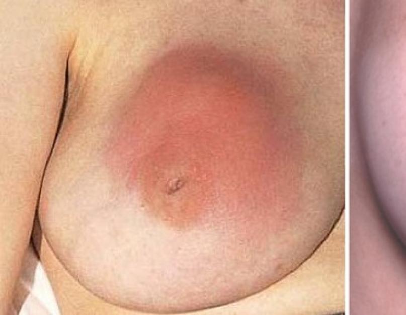 Punane joonistus rinnahaiguste vahel.  Punetus rinnus naisel ja mehel: põhjused, ravimid raviks.  Traditsiooniline meditsiin neuralgia ravis