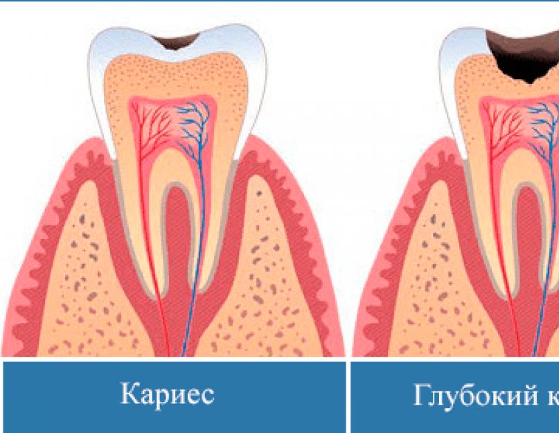 Krooniline parodontiit mcb ägenemise staadiumis.  Kuidas periodontiiti klassifitseeritakse?  K04 Periapikaalsete kudede haigused