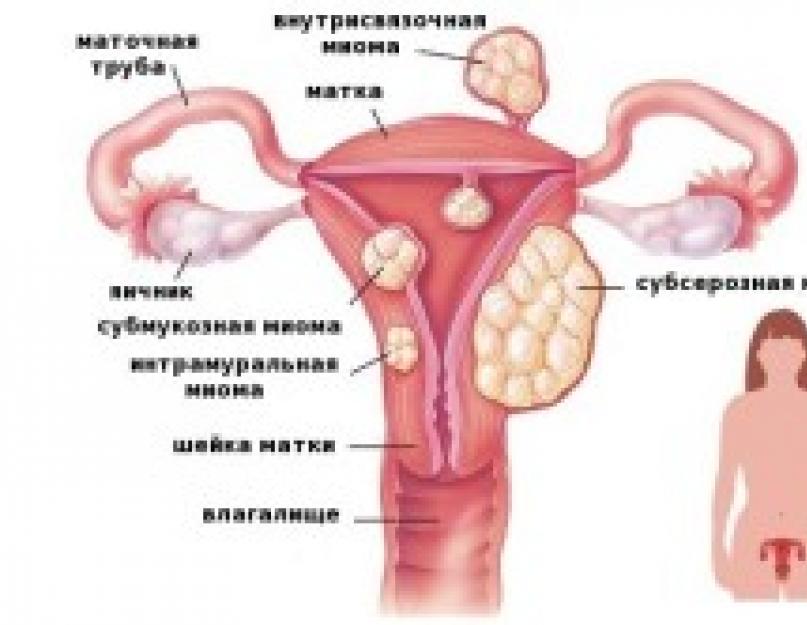 कई बड़े आकार के गर्भाशय फाइब्रॉएड का निदान।  एकाधिक गर्भाशय फाइब्रॉएड के उपचार के तरीके।  एकाधिक गांठदार गर्भाशय फाइब्रॉएड: यह क्या है