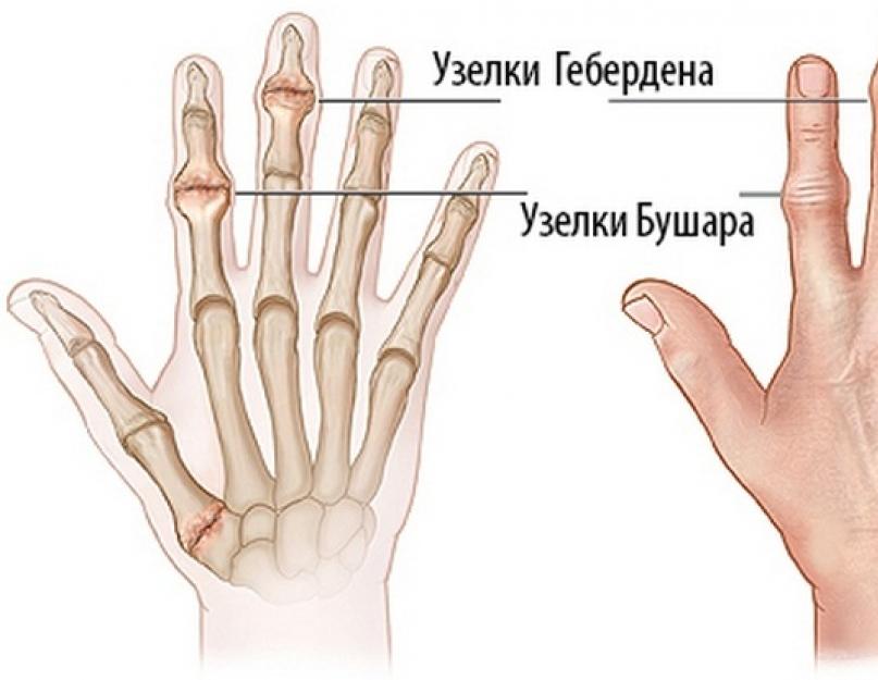 Дистальные межфаланговые суставы кисти фото