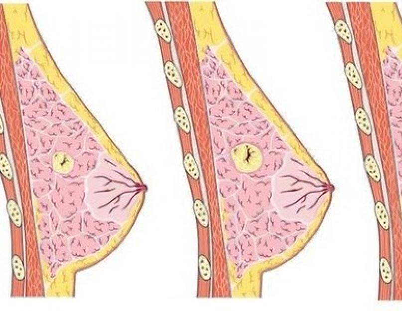 मास्टोपाथी और स्नान।  मास्टोपाथी के लिए स्वास्थ्य प्रक्रियाएं सौना में छाती में दर्द क्यों होता है