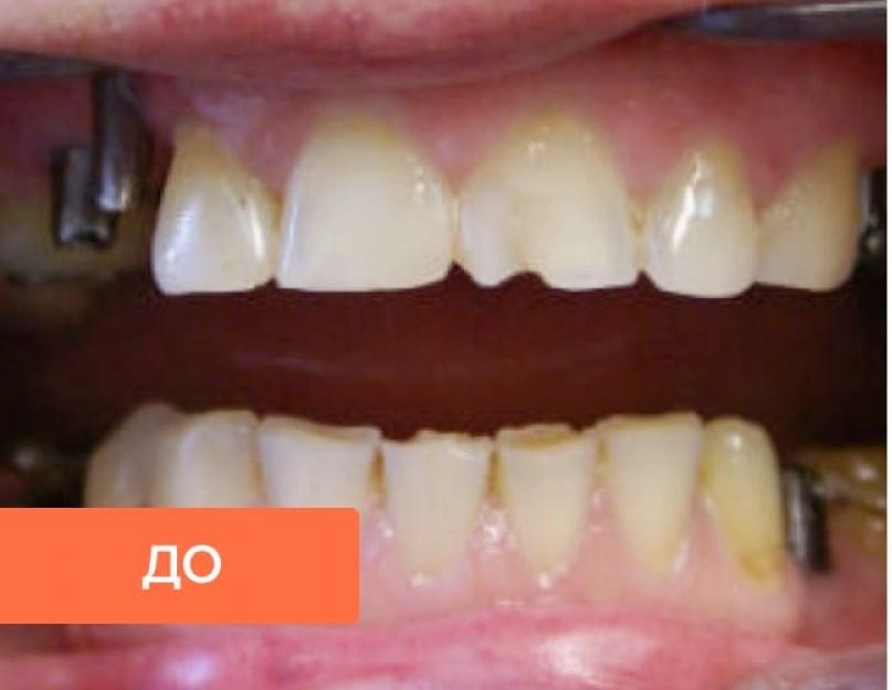 Основные виды протезирования зубов. Современные способы протезирования и технологии лечения: новые материалы для искусственных зубов и зубных протезов Какие виды протезов бывают