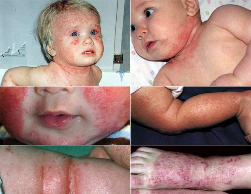 Laste atoopilise dermatiidi etioloogia patogeneesi kliinik.  Atoopiline dermatiit: etioloogia ja patogenees.  Kohustuslikud laboriuuringud