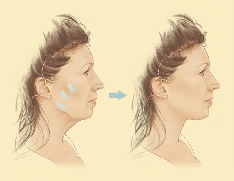 चेहरे के बीच के तीसरे हिस्से को एंडोस्कोपिक तरीके से उठाना।  सुरक्षित और उच्च गुणवत्ता वाला एंडोस्कोपिक फेसलिफ्ट।  पहले और बाद की तस्वीरों के साथ भारोत्तोलन प्रभाव