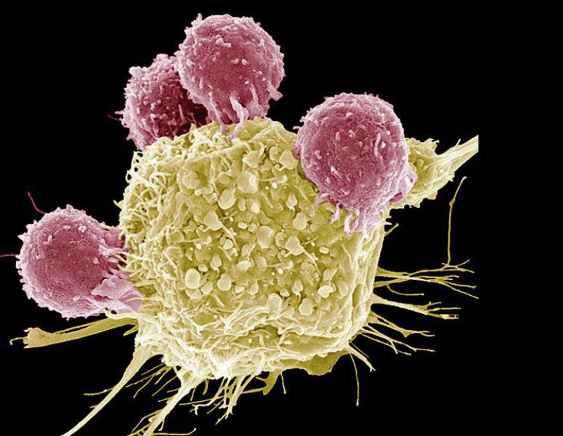 Существование взаимосвязи ракового заболевания с псориазом. Может ли псориаз перейти в рак кожи Болеющие псориазом не болеют раком