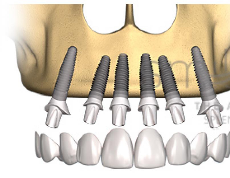 Импланты верхняя челюсть отзывы. Птеригоидальные импланты.