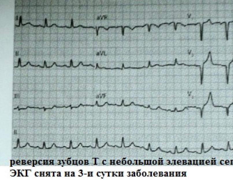 Muud muudatused ekg.  EKG tõlgendus: R-laine Mida tähendab kehv v1 tõus v4-le