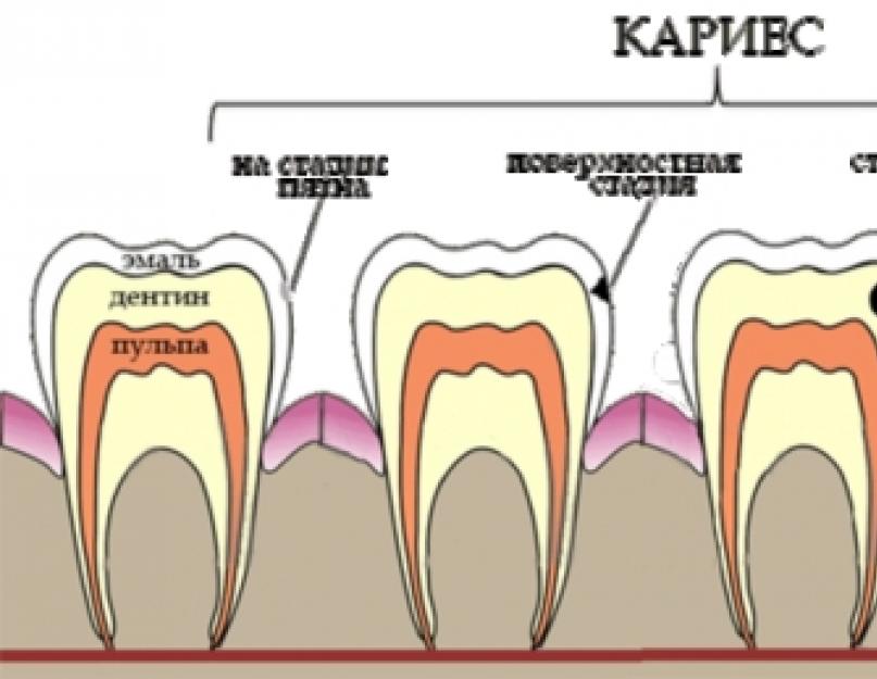 Esihammastele ilmuvad valged laigud.  Kuidas eemaldada hammastelt valged laigud.  Ortodontiline hambumuskorrektsioon