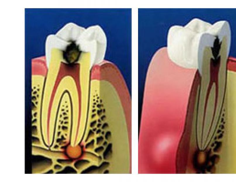 Granulomatoosne periodontiit on parodondi põletik, millega kaasneb tsüstogranuloomide moodustumine.  Granuleeriv parodontiit on hambajuuresüsteemi ohtlik haigus Haiguse arenguetapid