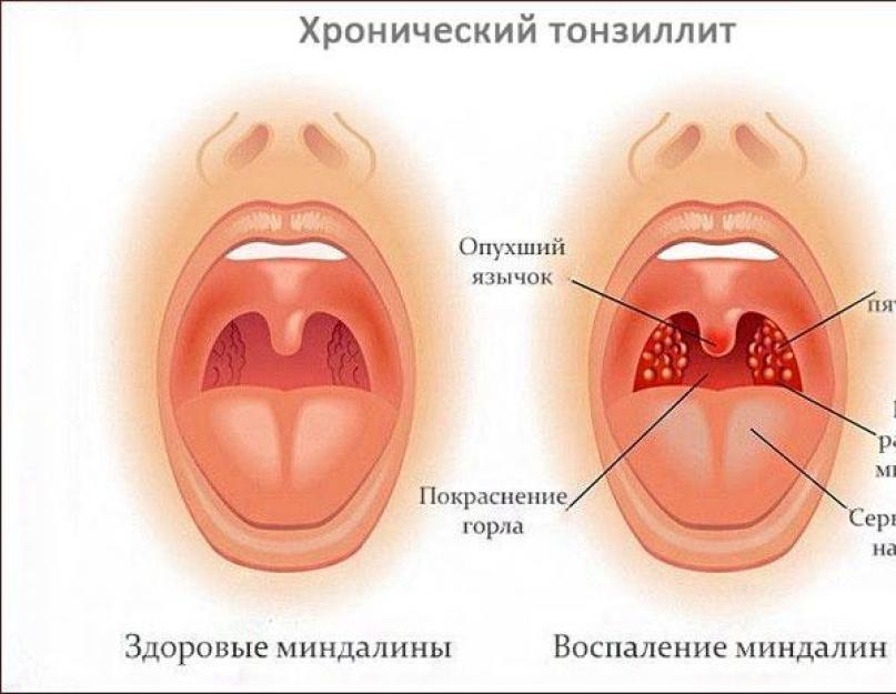 श्वसन तंत्र में संक्रमण.  ऊपरी श्वसन पथ के तीव्र और जीर्ण रोग ऊपरी श्वसन पथ के रोग राइनाइटिस ग्रसनीशोथ