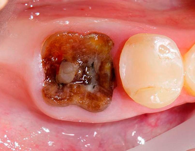 Tumenenud hammas krooni all.  Miks hambakroon tumenes ja mida teha?  Haige hamba visuaalne uurimine