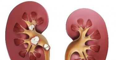 What causes kidney stones - doctors say