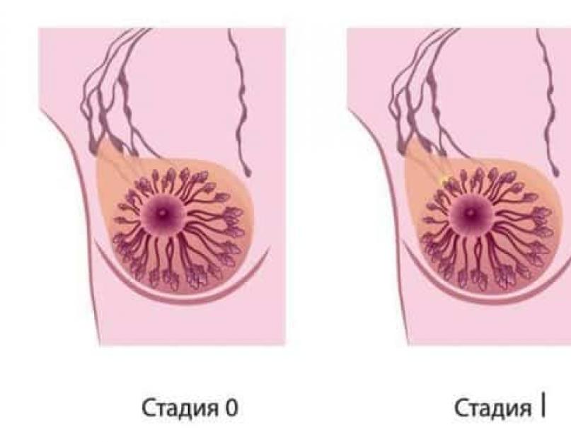 Рак молочной железы 1 2 стадия прогноз. Стадии, типы и лечение рака молочной железы. Способы лечения рака грудных желез