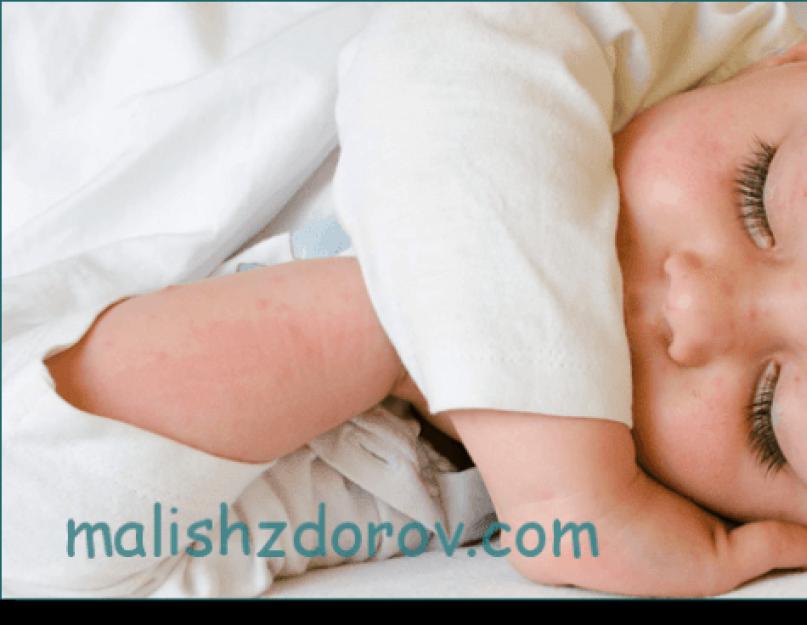 Lööve ninasillal lapsel põhjustab.  Lapse otsmikul väike lööve.  Nakkusliku päritoluga lööbe diferentsiaaldiagnostika