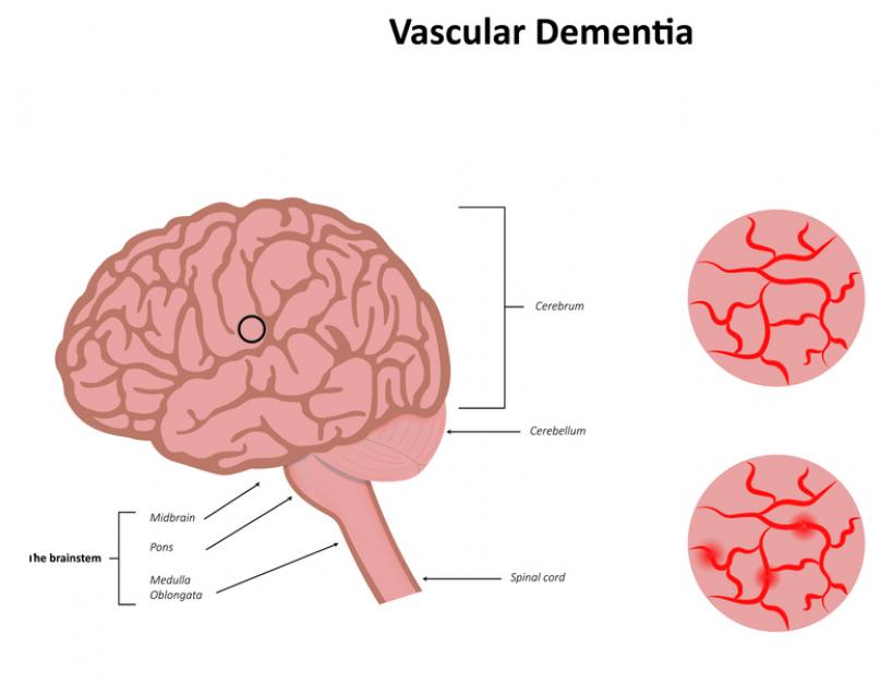 Dementsuse orgaaniline ja vaskulaarne erinevus.  Kas vaskulaarne dementsus on ravitav ja kui kaua nad sellise diagnoosiga elavad?  Vaskulaarne dementsus: kui kaua nad sellise diagnoosiga elavad