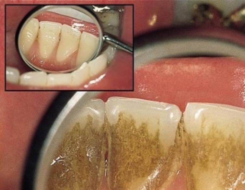 वायु प्रवाह दांतों की सफाई: पेशेवर, विपक्ष और रोगी समीक्षा।  एयरफ्लो - पेशेवर दांतों की सफाई: यह क्या है, वायु प्रवाह और अल्ट्रासोनिक सफाई के बीच अंतर पेशेवर वायु प्रवाह दांतों की सफाई